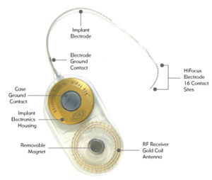 Cochlear implant (internal component)