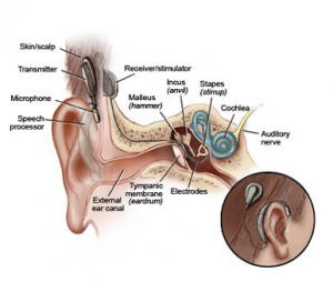 Cochlear implant (External component – behind the ear processor)