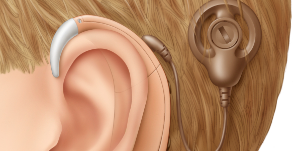 Cochlear Implant