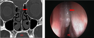 Cerebrospinal fluid rhinorrhoea